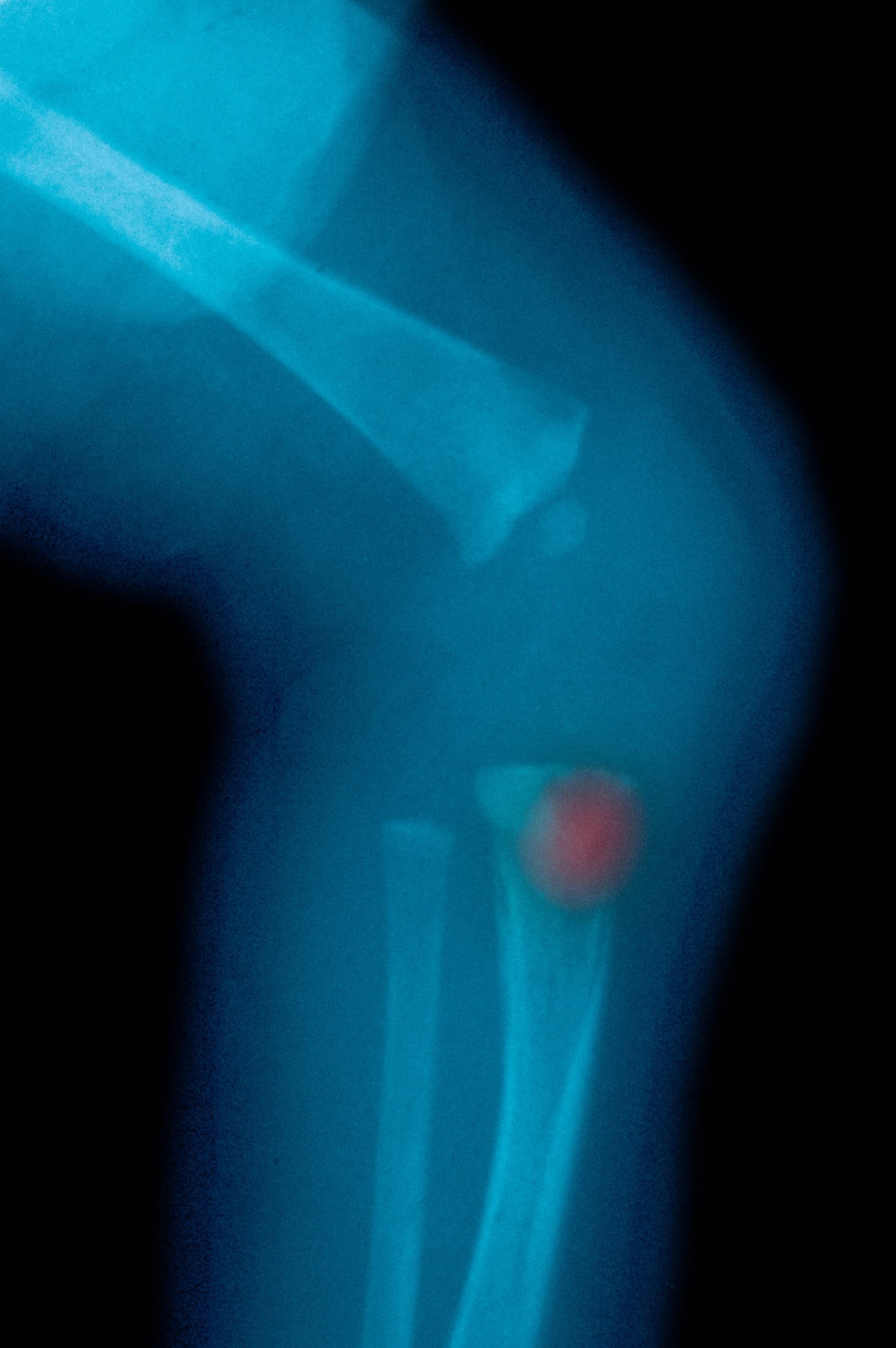 Congenital syphilis: knee xray of newborn, stock photo.