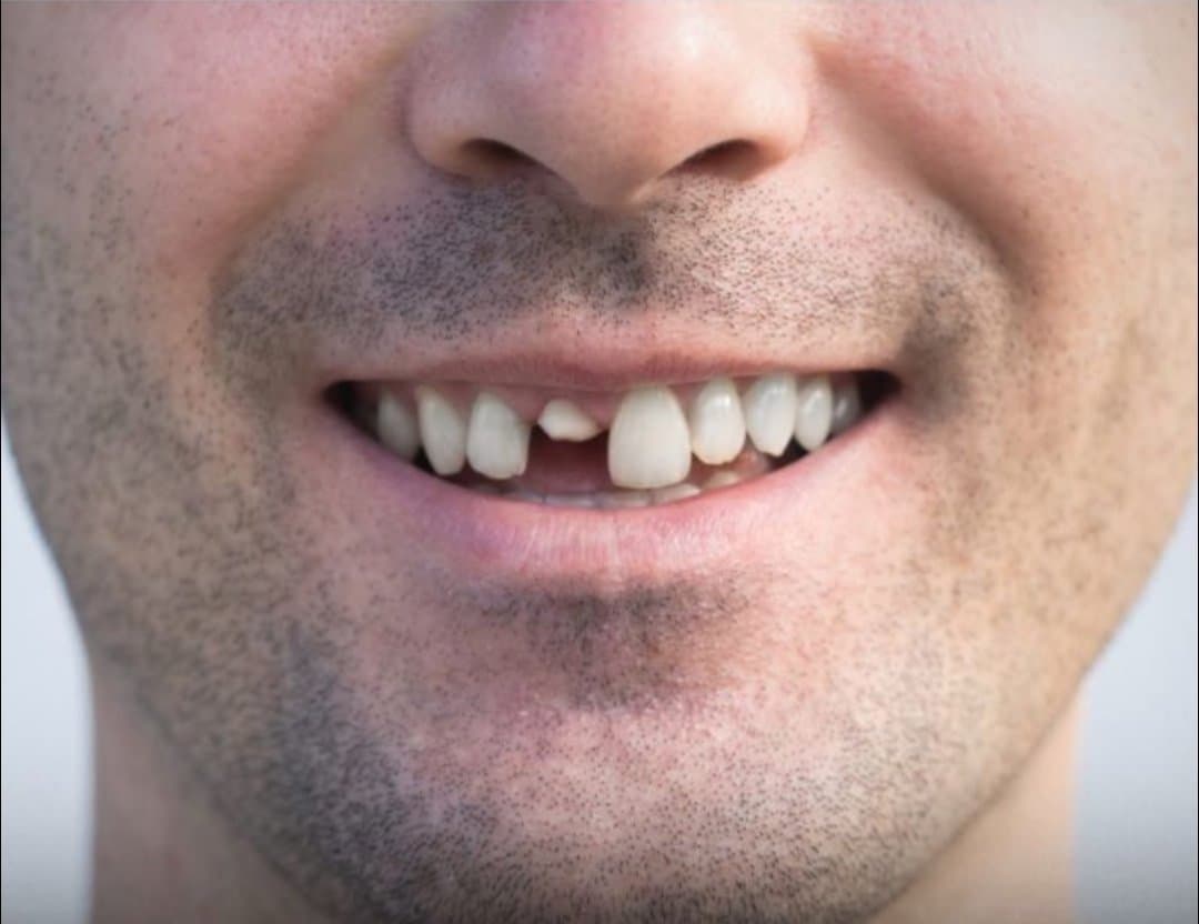 Via X An experimental drug being tested in Japan may enable adults to grow new teeth to replace broken or diseased teeth like the one seen here.