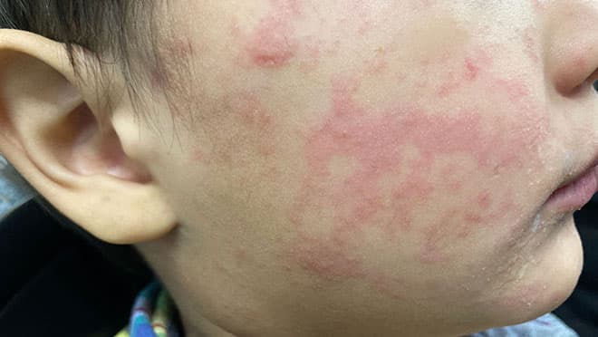 Centers for Disease Control and Prevention A child’s cheek shows the characteristic rash associated with measles.